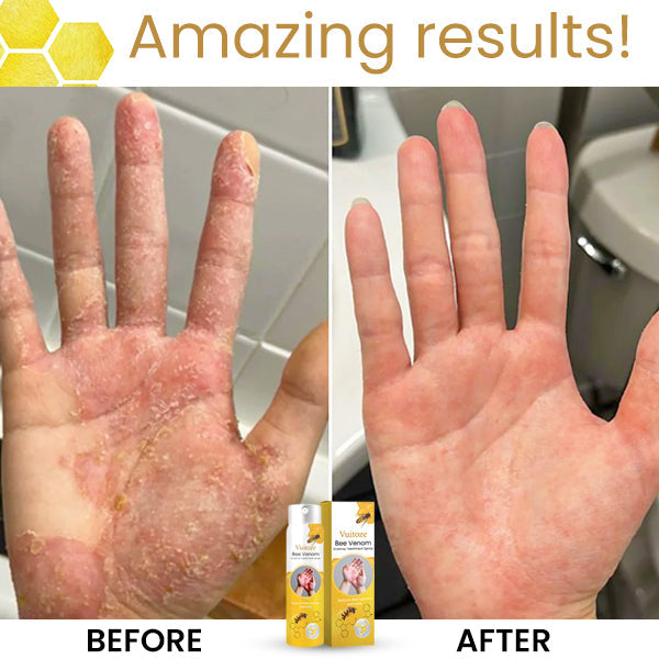 Vuitoze™ Bee Venom Eczema Treatment Spray